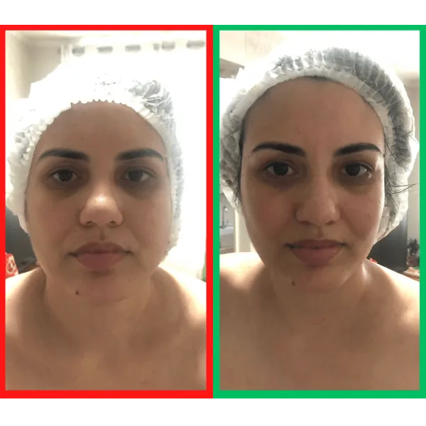 Antes e depois da massagem para desinchar